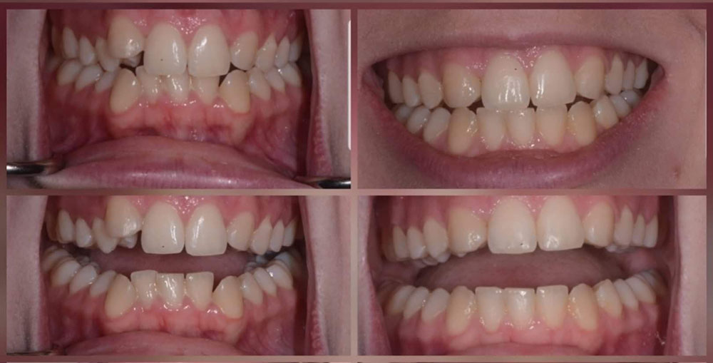 Adult Braces - Before & After